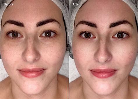 icing face results|Ice for Face: Benefits of Cold Facials and How to Do .